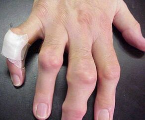 liigeste deformatsioonidega sõrmed põhjustavad valu